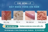 Ngứa vùng kín nam là bệnh gì? Nguyên nhân, triệu chứng và cách điều trị