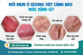 Dương vật bị nổi mụn nước là bệnh gì? Cách điều trị hiệu quả