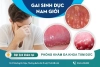 Gai sinh dục ở nam giới và những điều cần biết