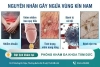 Ngứa vùng kín nam - nguyên nhân, triệu chứng và cách điều trị