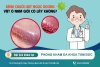 Bệnh chuỗi hạt ngọc có lây không? Con đường lây lan của chuỗi hạt ngọc