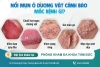Dương vật nổi mụn: Nguyên nhân, cách điều trị