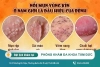 Vùng kín bị nổi mụn và cách điều trị hiệu quả