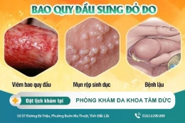 Bao quy đầu sưng đỏ có phải bị viêm? Cách nhận biết viêm bao quy đầu