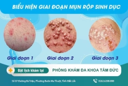 Bật mí phương pháp điều trị mụn rộp sinh dục hiệu quả cao