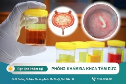 Nước tiểu màu vàng là dấu hiệu của bệnh gì? Điều trị như thế nào?