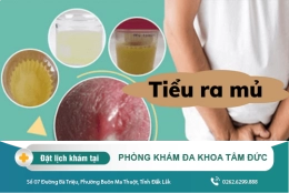 Đi tiểu ra mủ là bệnh gì? Cách chữa trị tiểu ra mủ hiệu quả