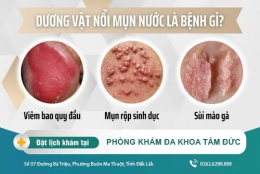 Dương vật bị nổi mụn nước là bệnh gì? Nguyên nhân và cách điều trị hiệu quả