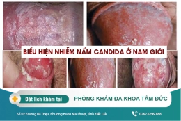 Nấm candida ở nam giới - Nguyên nhân và cách điều trị