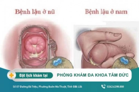 Phương pháp điều trị bệnh lậu tại Đắk Lắk – Hiện tượng bệnh lậu là gì?