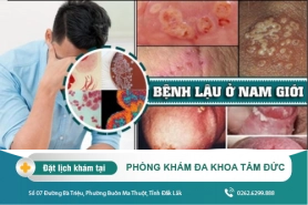Cách điều trị bệnh lậu hiệu quả tại Đắk Lắk - Dấu hiệu bệnh lậu ở nam giới là gì?