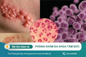 Cách điều trị bệnh lậu tại Đắk Lắk – Triệu chứng bệnh lậu là gì?