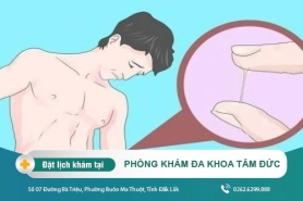 Cách điều trị bệnh kim la tại Đắk Lắk – Các dấu hiệu của bệnh kim la là gì?