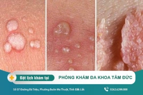Cách điều trị sùi mào gà tại Đắk Lắk - Dấu hiệu và nguyên nhân của bệnh sùi mào gà là gì?