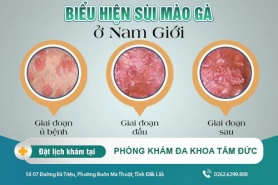 Phương pháp điều trị bệnh sùi mào gà tại Đắk Lắk - Bệnh sùi mào gà có lây không?