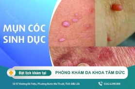 Dấu hiệu của mụn cóc sinh dục? Cách chữa trị đơn giản nhanh chóng