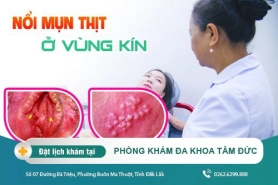 Nổi mụn thịt ở vùng kín là gì? Nguyên nhân, triệu chứng và cách chữa trị thế nào
