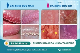 Gai sinh dục có nguy hiểm không? Cách chữa gai sinh dục hiệu quả