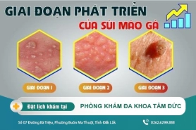 Sùi mào gà vùng kín có những giai đoạn nào? Điều trị sớm để hiệu quả được nâng cao