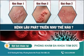 Nhận biết sớm các giai đoạn của bệnh lậu