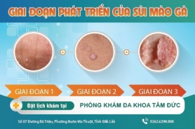 Nhận biết sớm bệnh sùi mào gà qua từng giai đoạn