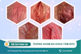 Khắc phục nổi mụn ở lông mu nữ giới nhanh chóng bằng phương pháp hiện đại