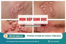 Vùng kín nổi mụn nước có tự khỏi không? Cách điều trị mụn nước ở vùng kín