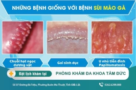 Bệnh dễ nhầm với sùi mào gà là gì? Cách nhận biết và điều trị ra sao