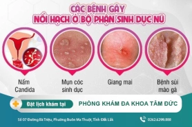 Tìm hiểu về nổi hạch ở bộ phận sinh dục nữ. Cách điều trị bệnh