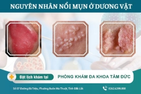 Bìu nổi mụn là do nguyên nhân gì gây ra. Cách điều trị bìu nổi mụn như thế nào