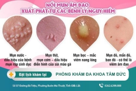 Tìm hiểu các loại mụn ở vùng kín và cách khắc phục hiệu quả