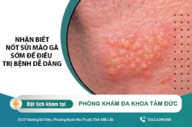 Bệnh sùi mào gà có lây không? biện pháp khắc phục hiệu quả