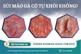 Sùi mào gà có tự khỏi không? Quá trình phát triển bệnh thế nào?