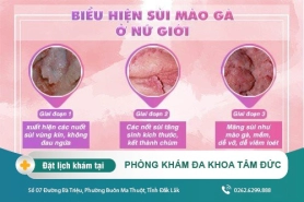 Sùi mào gà ở nữ giới và các phương pháp điều trị phù hợp