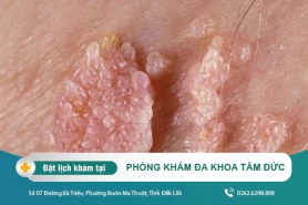 Phương pháp chữa sùi mào gà tại Đắk Lắk – Bệnh sùi mào gà là gì?