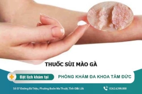 Thuốc hỗ trợ điều trị bệnh sùi mào gà nhanh hiệu quả