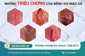 Cách chữa sùi mào gà ở hậu môn như thế nào?