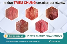 Dấu hiệu của bệnh sùi mào gà - Phát hiện và điều trị bệnh ngay