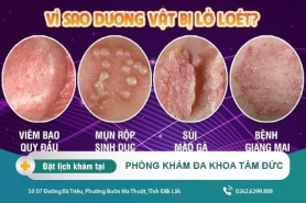 Dương vật bị lở có nguy hiểm không? Chữa bằng cách nào