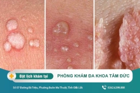 Cách điều trị sùi mào gà tại Phòng Khám Đa Khoa Tâm Đức - Dấu hiệu của bệnh sùi mào gà là gì?