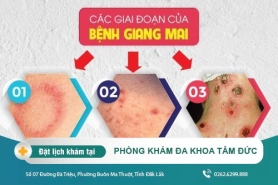 Giang mai là gì? Dấu hiệu bệnh giang mai