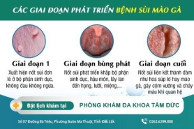 Cách chữa sùi mào gà tại Đắk Lắk - Bệnh sùi mào gà giai đoạn đầu có dấu hiệu gì?