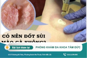 Địa chỉ chữa bệnh sùi mào gà tại Đắk Lắk – Đốt sùi mào gà có hiệu quả không?