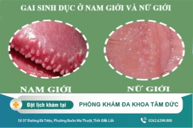 Mách bạn cách điều trị gai sinh dục hiệu quả hiện nay