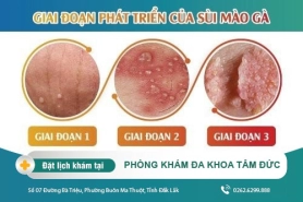 Cách điều trị sùi mào gà giai đoạn cuối tại Đắk Lắk – Bệnh sùi mào gà có mấy giai đoạn?