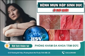 Thông tin chi tiết về mụn rộp sinh dục ở nữ giới