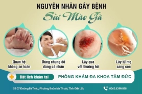 Sùi mào gà - Bệnh liên quan đến vùng kín phổ biến hiện nay