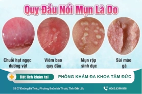 Nổi mụn bao quy đầu có nguy hiểm không? Nguyên nhân do đâu?