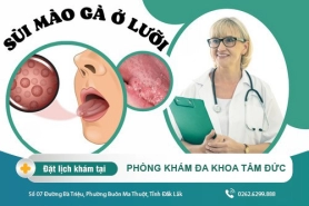 Giải đáp hiện tượng sùi mào gà ở lưỡi
