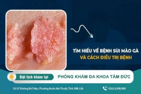 Cách trị sùi mào gà tại Đắk Lắk – Bệnh giả sùi mào gà là bệnh gì?